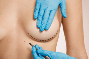 Breast Augmentation